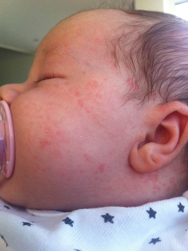 Babyakne Oder Doch Lieber Nochmal Zum KiA? - Baby: Babyforum.de